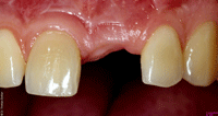 Implantologie, Zahnimplantat vor dem Eingriff