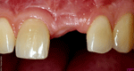Zahnlücke vorher