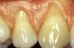Parodontosebehandlung vor dem Eingriff